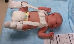 Массаж при дисплазии тазобедренного сустава у новорожденных детей