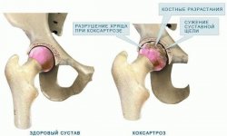 Лечение коксартроза тазобедренного сустава 3 степени без операции