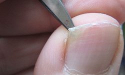 Ушиб ногтя на руке и ноге: что делать, чем лечить
