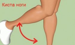 Киста на ноге: причины, симптомы и методы лечения