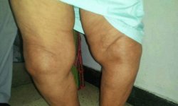 Артроз коленного сустава 4 степени: лечение, симптомы и профилактика