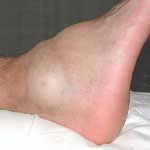 Отек коленного сустава причины лечение и как снять отек с коленного сустава