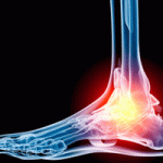 Остеосклероз: костей, суставов, тел позвонков, причины, лечение. Причины и лечение остеосклероза коленного сустава